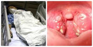 Thờ ơ với triệu chứng đau họng người phụ nữ tá hỏa khi bác sĩ thông báo mình mắc bệnh nan y